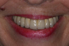 Dental Implants Dentist East Molesey After