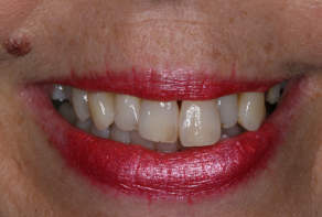 Dental Implants Dentist East Molesey Before