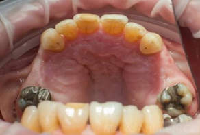 Dental Implants Dentist East Molesey before