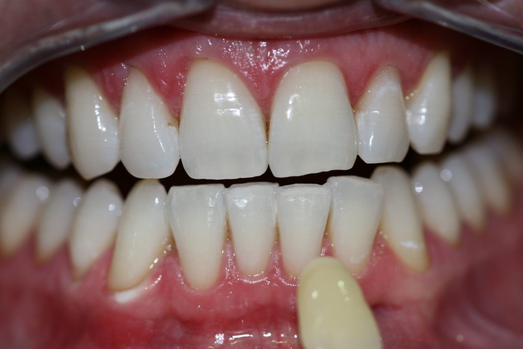 teeth whitening after client 2