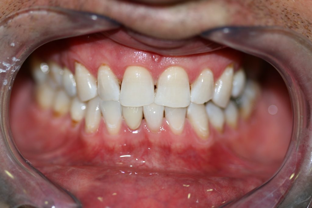 teeth whitening after client 5