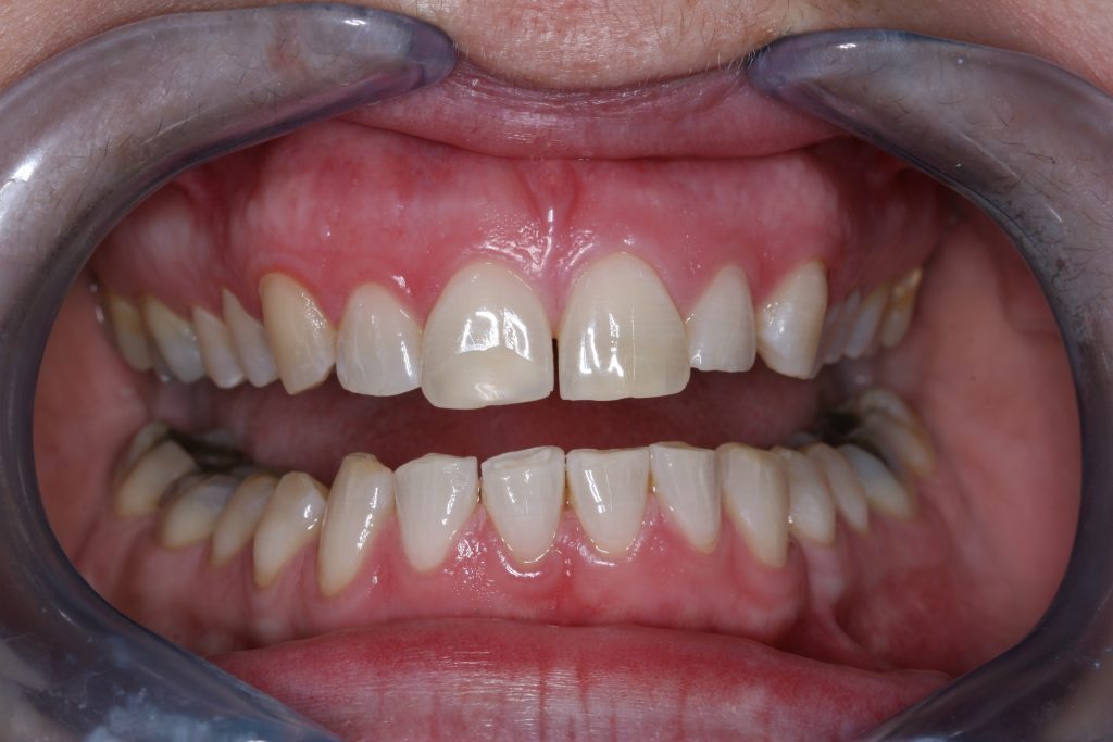 teeth whitening after client 7
