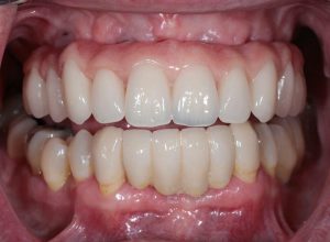 Dental Implants client 6a