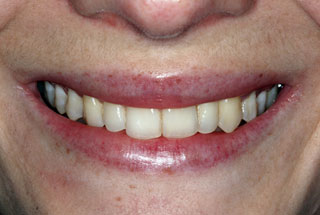 Crooked teeth after client 2