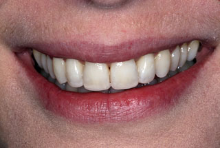 Crooked teeth after client 3
