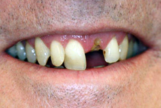 Dental implants before client 2