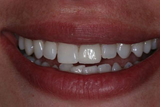 Single tooth whitening client 1 after