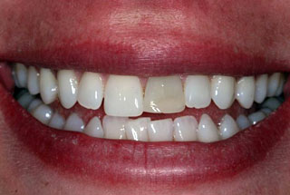 Single tooth whitening client 1 before