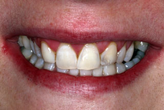 Teeth whitening after client 2